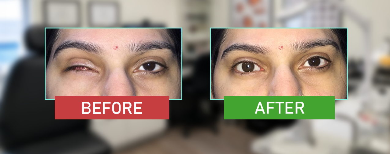 artificial eye before-after
