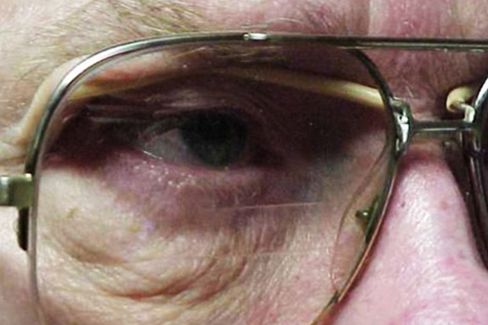  Ptosis Correction 